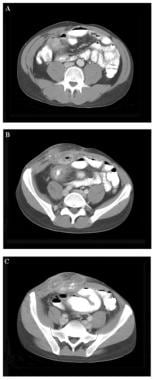 Peritonitis and abdominal sepsis. A 35-year-old ma