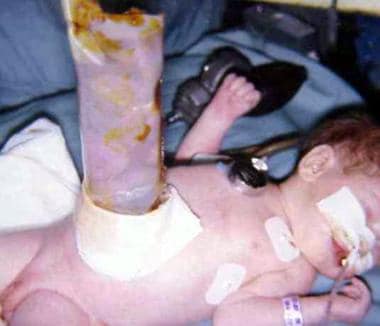 Infant with Silon chimney placed in treatment of g