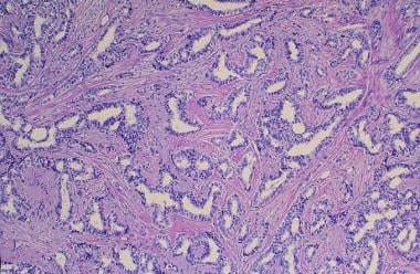 Breast cancer. Infiltrating ductal carcinoma. Low-
