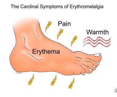 Cardinal symptoms of erythromelalgia. 