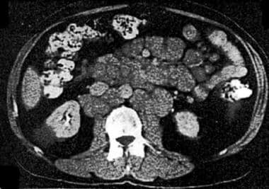 Computed tomography (CT) scan of the abdomen showi