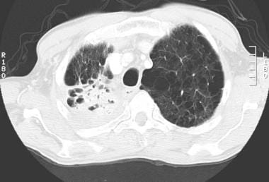CT thorax of a patient with classic right upper lo