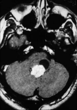 Imaging appearance of a fourth ventricular choroid