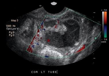 Endovaginal ultrasonogram reveals tubular structur