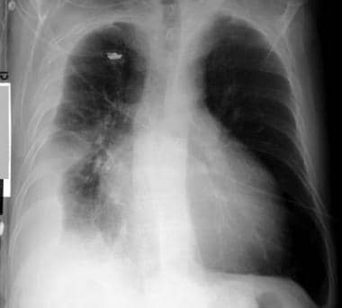 A right lateral decubitus chest radiograph shows a