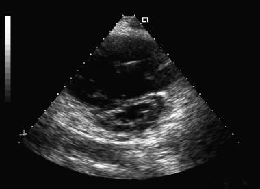 Two-dimensional short-axis echocardiogram image. N