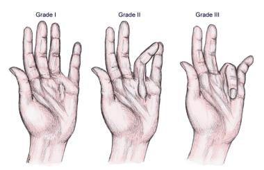 Three clinical grades of Dupuytren disease. 