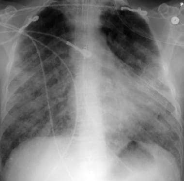 Pulmonary alveolar capillaritis. 