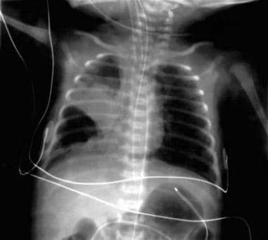 Chest radiograph of child with large right-side br