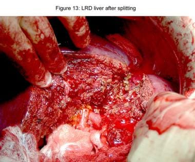 Liver transplantation. Living-related donor liver 