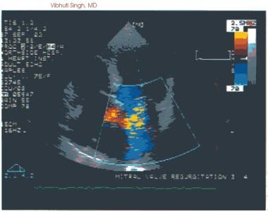 Acute mitral regurgitation. Severe mitral regurgit