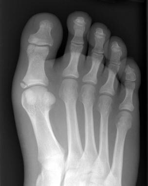 Foot Fracture: Background, Epidemiology, Patient Education