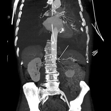 Avulsed left renal artery with thrombosis. 