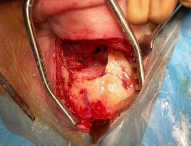 Mastoidectomy has been performed, as well as facia