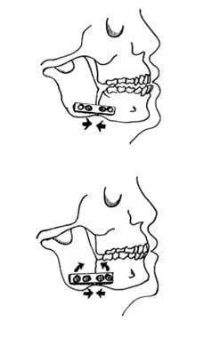 Mandibular Fracture Reduction with Eccentric Dynamic Compression Plate: New  Treatment for an Old Problem