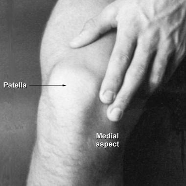 Patella in a male patient, medial aspect. 