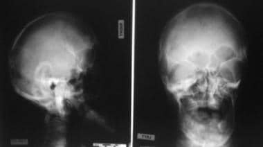 This radiograph demonstrates turribrachycephaly, s