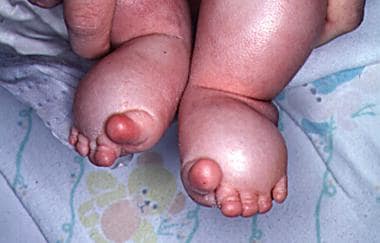 Lymphedema of the feet in an infant is shown. The 