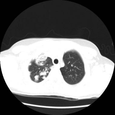 Follow-up CT scan of the thorax (lung windows) of 