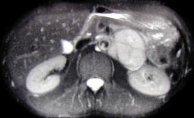 Axial, T2-weighted MRI scan showing large left sup