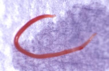 The roundworm Ascaris lumbricoides causes ascarias