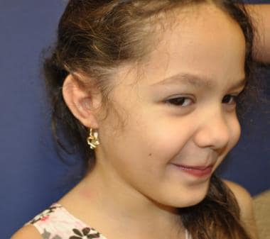 Patient with grade III microtia and atresia after 