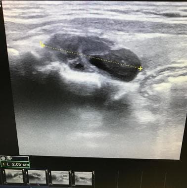 Sagittal ultrasound view of the same 2 gram left s