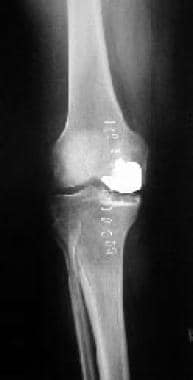 Immediate postoperative radiograph of a medial uni