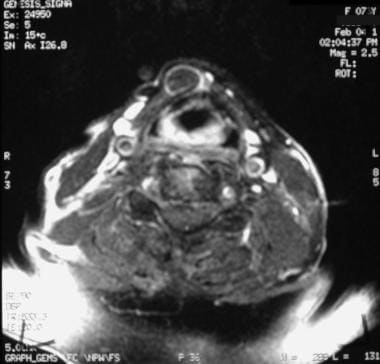 Axial T1-weighted image obtained following intrave
