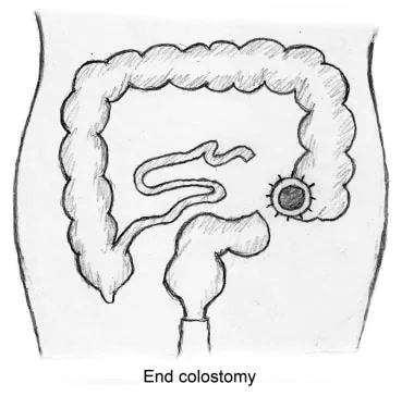 Schematic representation of colon and rectum after