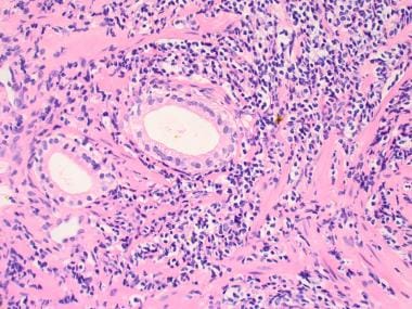 Pathology of Prostate Leukemia and Lymphoma. Margi