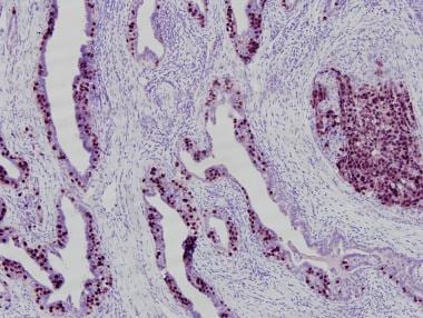 Pathology of embryonal carcinoma. OCT3/4 immunohis