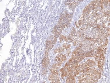 Metastatic ovarian granulosa cell tumor to the lun