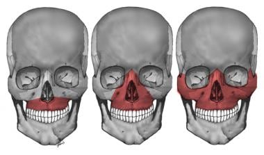 Le Fort I, II, and III maxillary fractures. 