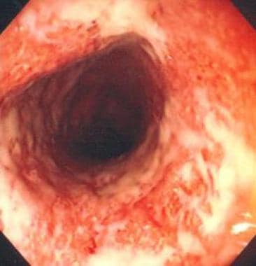 结肠镜下可见溃疡性结肠炎。