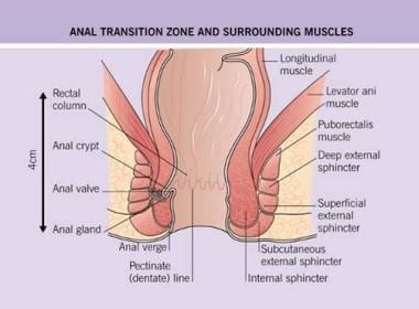 Anal Surgery for Hemorrhoids: Background, Indications, Contraindications