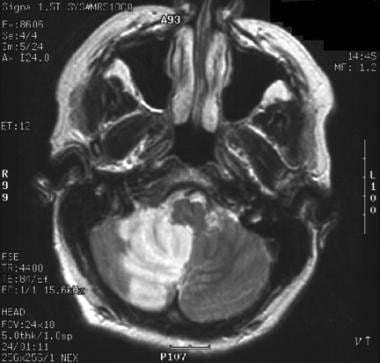 MRI of a 56-year-old woman with right cerebellar i