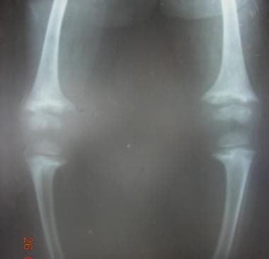 Abnormal epiphysis in rickets. 