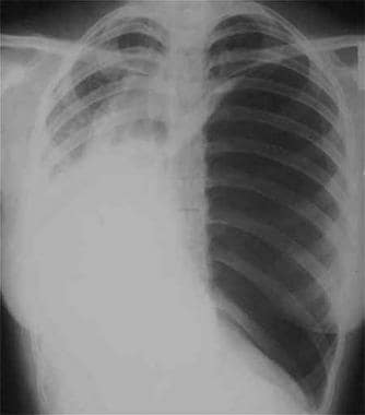 Radiograph of a patient with a large spontaneous t