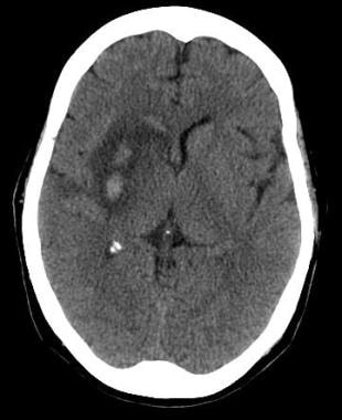 Axial noncontrast CT scan of the brain in a 60-yea