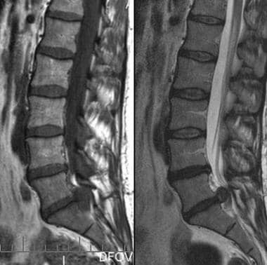 Right S1 radiculopathy. Sagittal T1- and T2-weight