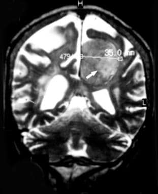 Coronal T2-weighted magnetic resonance image demon
