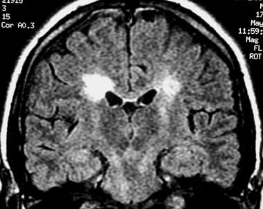 Coronal fluid-attenuated inversion recovery (FLAIR