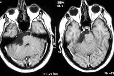 Axial contrast-enhanced T1-weighted MRIs show an e
