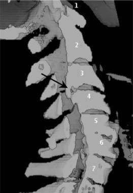 Sagittal volume reconstruction of a computed tomog