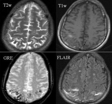 MR imaging shows subarachnoid hemorrhage (SAH). SA