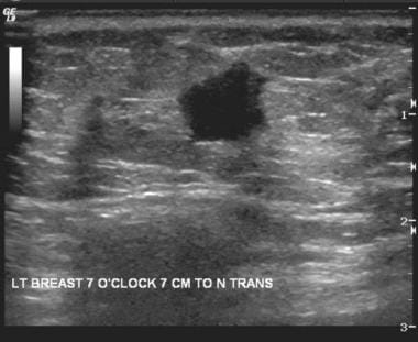 Ultrasound shows a suspicious hypoechoic mass with