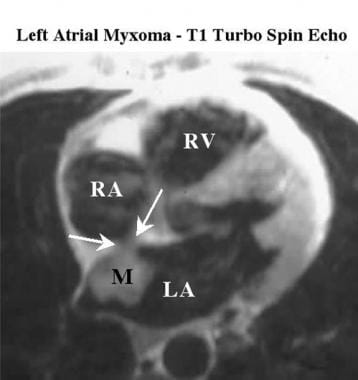 T1-weighted turbo spin-echo MRI scan shows interme