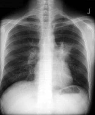 Chest radiograph demonstrates a spiculated mass ov