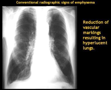 chest emphysematous emphysema lungs radiograph vascular pulmonary imaging markings hyperinflated reduced radiography patient shows hila suggesting prominent degree some